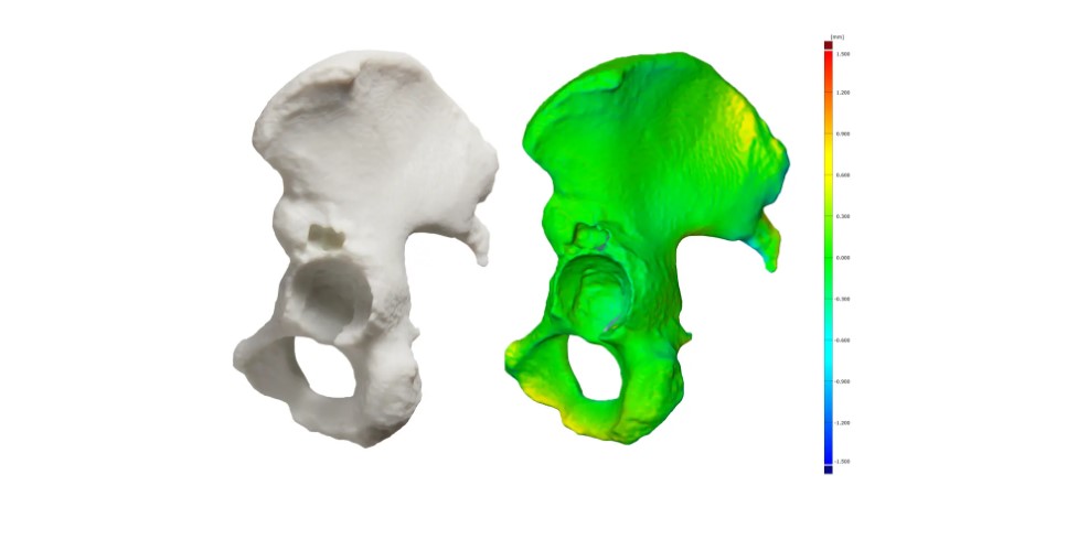 3D 列印解剖髂骨